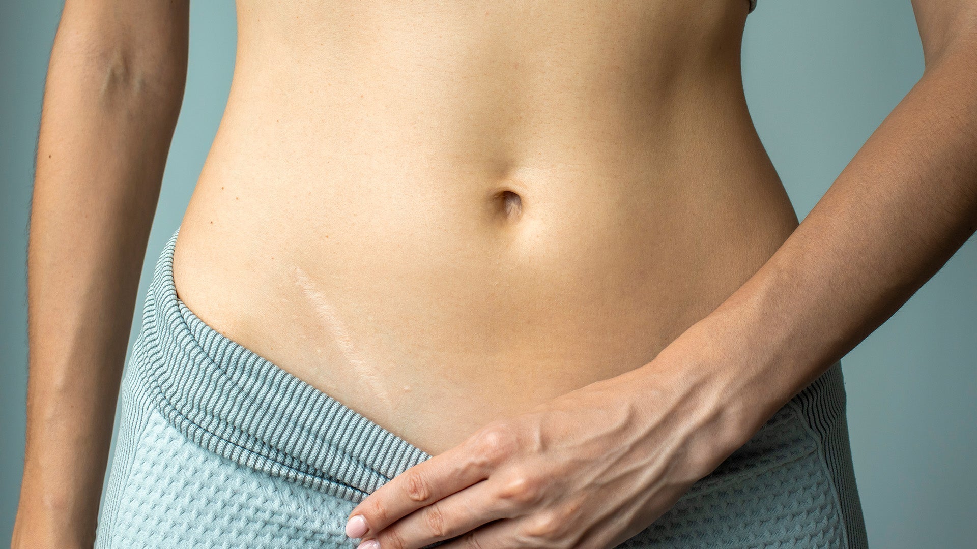 Using Spidertech For Damaged Skin: Post-Surgical Scars & Scar Healing